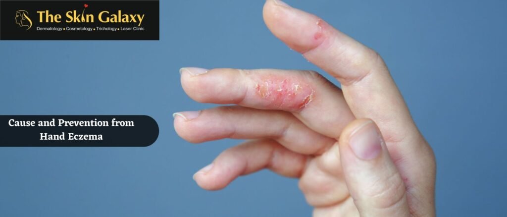 Hand Eczema? | The Skin Galaxy | Bhandup, Mumbai