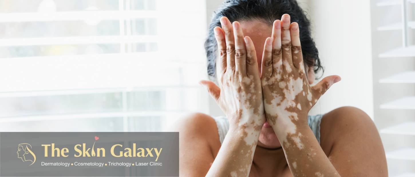 Vitiligo treatment in Bhandup Mumbai The Skin Galaxy