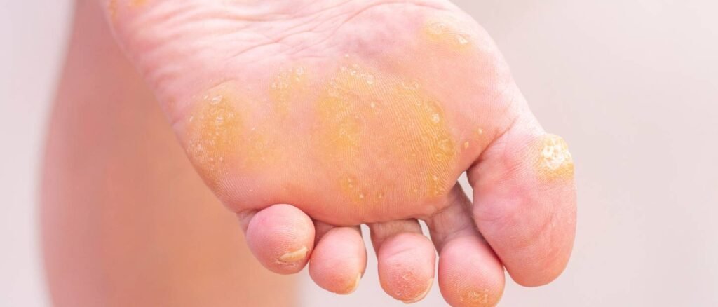 Plantar Eczema Treatment | The Skin Galaxy