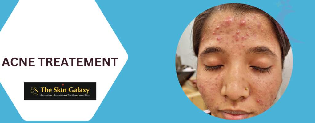 Acne Treatment | The Skin Galaxy | Bhandup