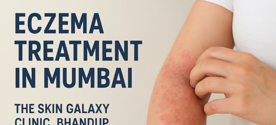 Eczema Treatment in Mumbai The Skin Galaxy