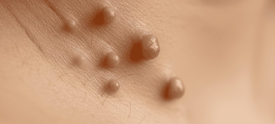 Are Skin Tags Contagious?